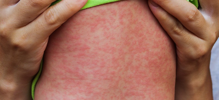 A child with a rash caused by the measles virus.